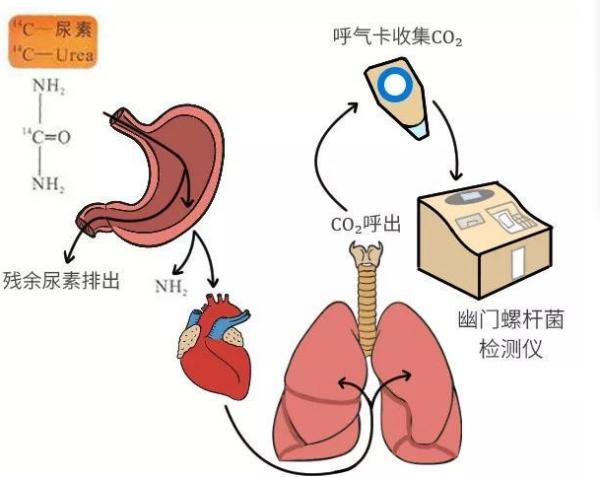 幽門螺旋桿菌最新治療方法探討