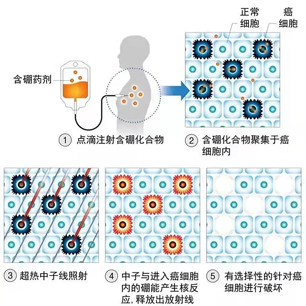 硼中子治療最新進(jìn)展與小巷特色小店的神秘面紗